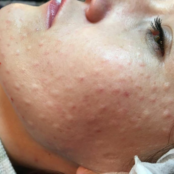 Мезотерапія
                    Косметологічний центр Healthy & beauty club Київ