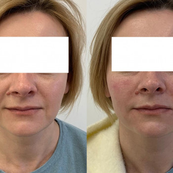 Біоревіталізація (методом 7 вколів)