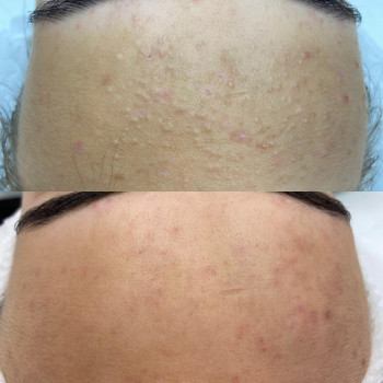 Чистка обличчя