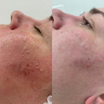 Чистка обличчя