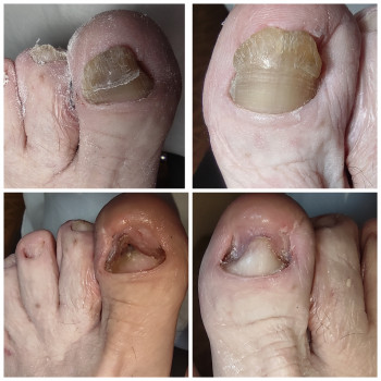 Обработка онихогрифоза(утолщение ногтевой пластины)