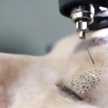 Ліфтинг верхніх повік.