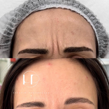 Ботулотоксин