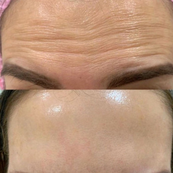 Ботулинотерапия