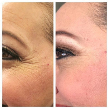 Ботулінотерапія
                    Косметолог-инъекционист Євгенія Ивано-Франковск