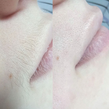 Шугаринг бикини
                    Майстер депіляції Лиана Суми