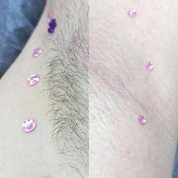 Шугаринг
                    Майстер депіляції Лиана Суми