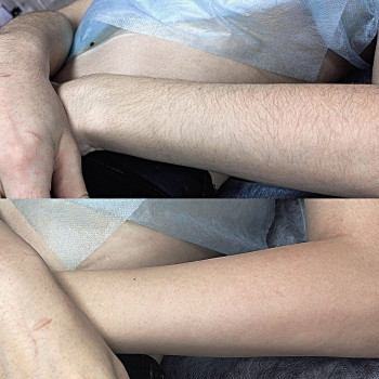 Шугаринг
                    Майстер депіляції Лиана Суми