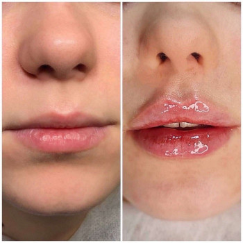   губ
  пластика губ
  асиметрії губ