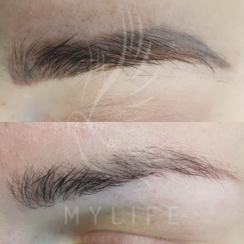 Видалення татуажу