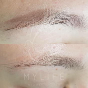 Видалення татуажу