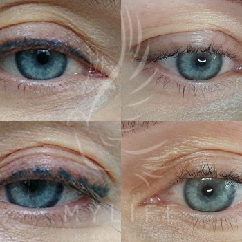 Видалення татуажу