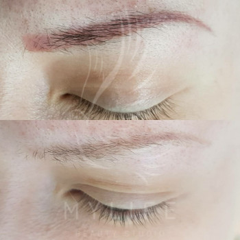 Видалення татуажу