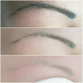 Видалення татуажу