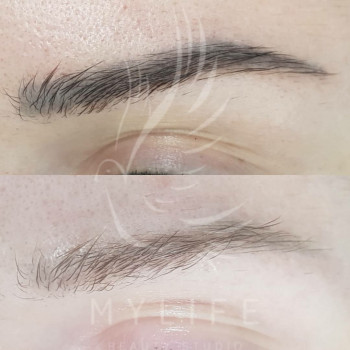 Видалення татуажу