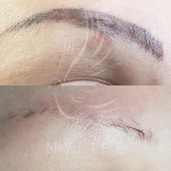 Видалення татуажу