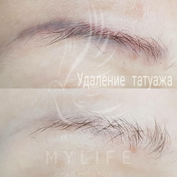 Видалення татуажу