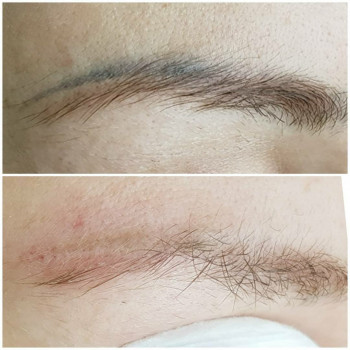 Видалення татуажу