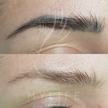 Видалення татуажу