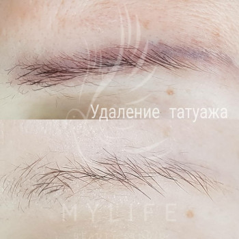 Видалення татуажу