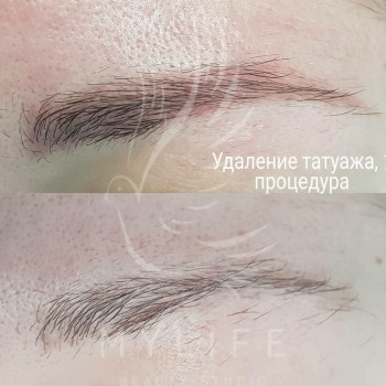 Видалення татуажу