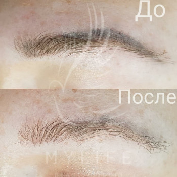 Видалення татуажу