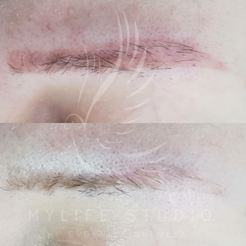 Видалення татуажу