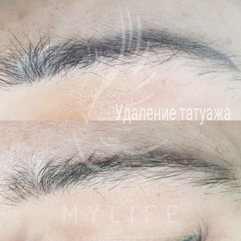 Видалення татуажу