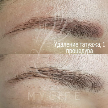 Видалення татуажу