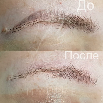 Видалення татуажу