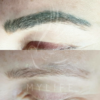 Видалення татуажу