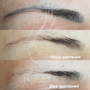 Видалення татуажу