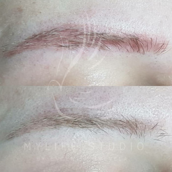 Видалення татуажу