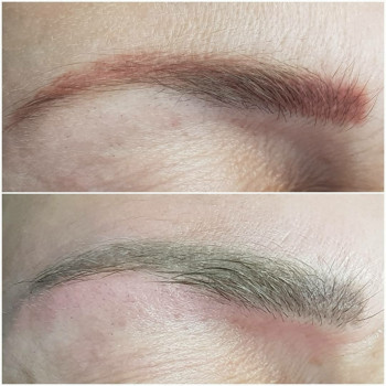 Видалення татуажу