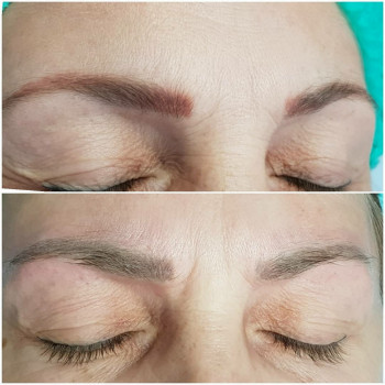 Видалення татуажу