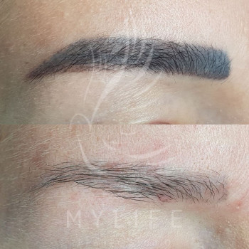 Видалення татуажу