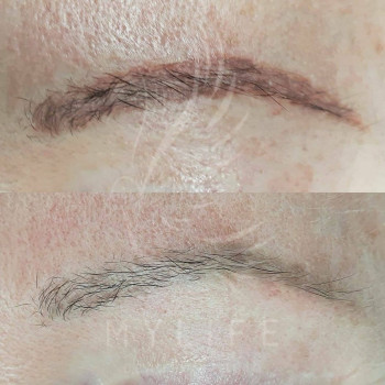 Видалення татуажу