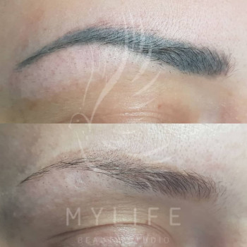 Видалення татуажу