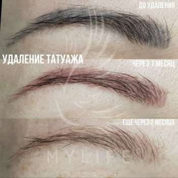 Видалення татуажу