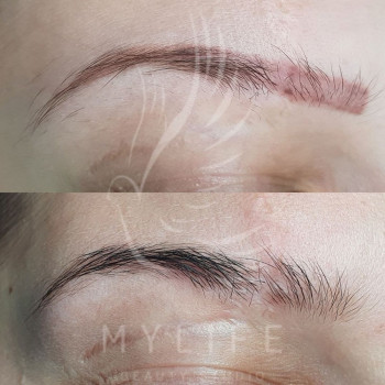 Видалення татуажу