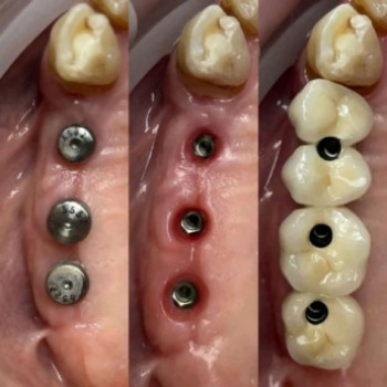 Імплантація