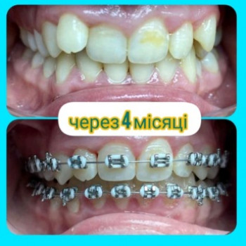 Брекет-система