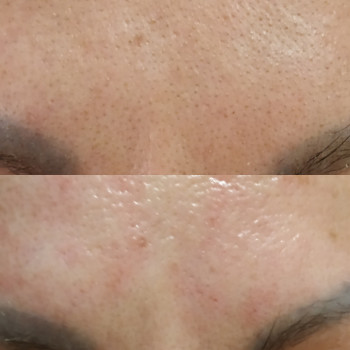 механическая чистка