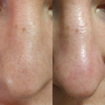 чистка, жирная, пористая кожа