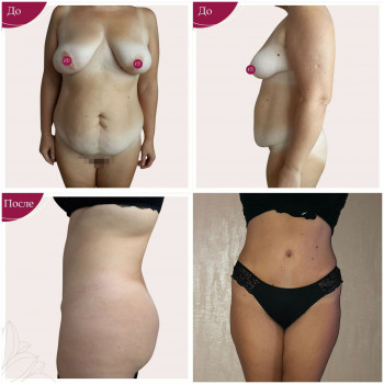 Абдоминопластика с липосакцией 360* и умеренным липофилингом