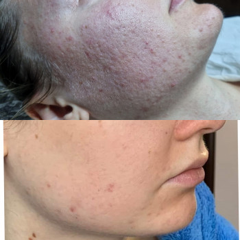 Лікування акне