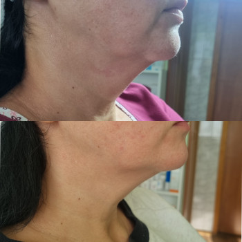 Ботокс "Ліфтинг Ніфертіті "