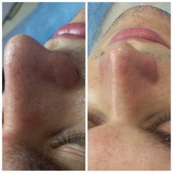 Чистка обличчя + Альгінатна маска у подарунок!
                    Косметолог Лілія Винница