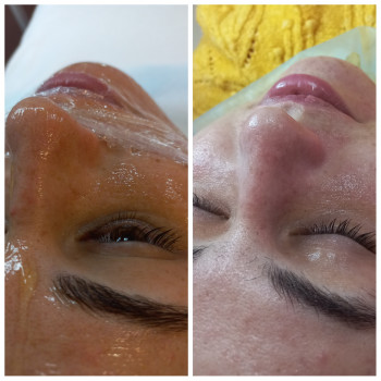 Чистка обличчя + Альгінатна маска у подарунок!
                    Косметолог Лілія Винница