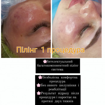 Radiance Peel (пілінг)
                    Косметолог Лілія Вінниця